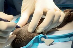 incisão midge para aumento cirúrgico do pênis
