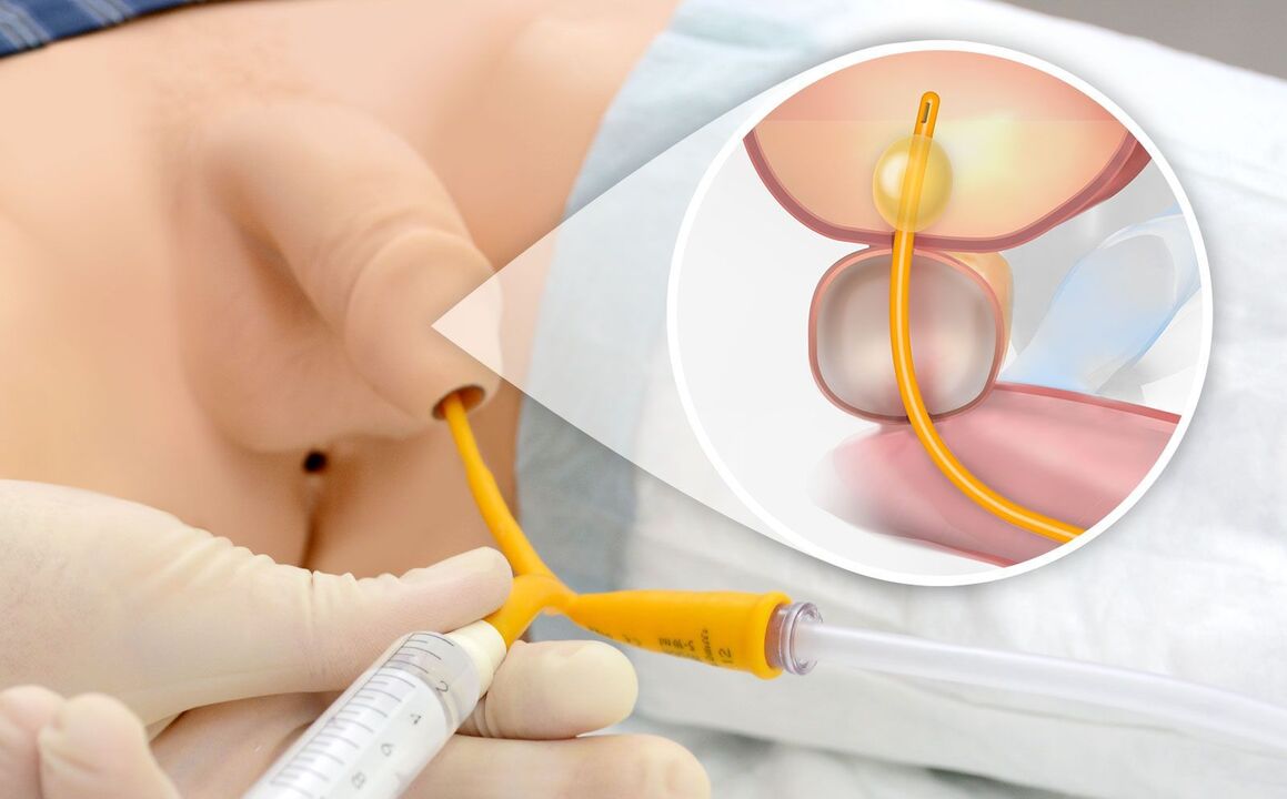 lipofilling para crescimento do pênis