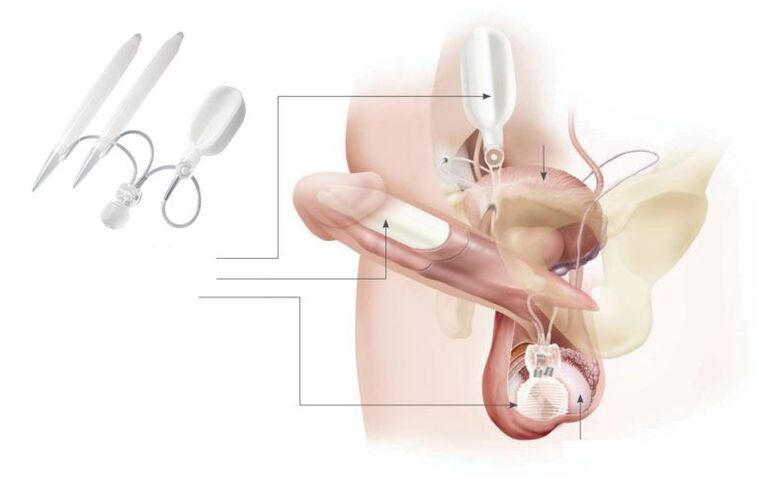 implantes de gel no pênis