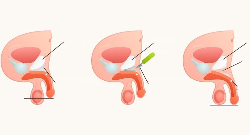 ligamentotomia para aumento do pênis